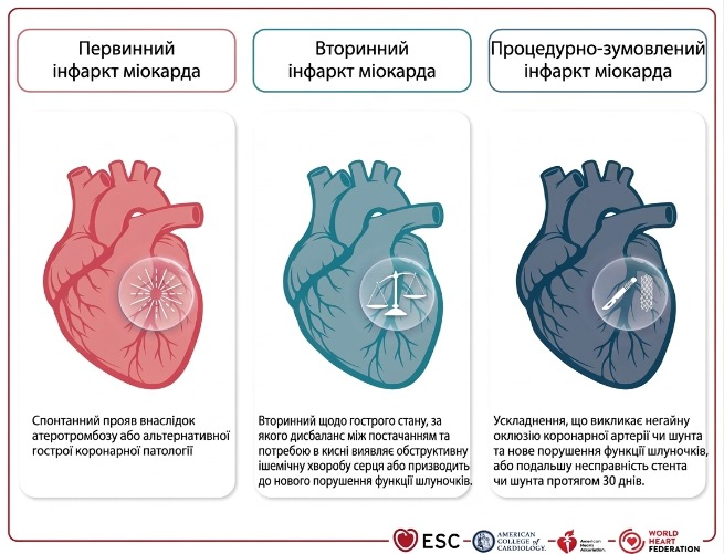 П’яте універсальне визначення інфаркту міокарда — 2026: оновлено критерії діагностики та класифікації